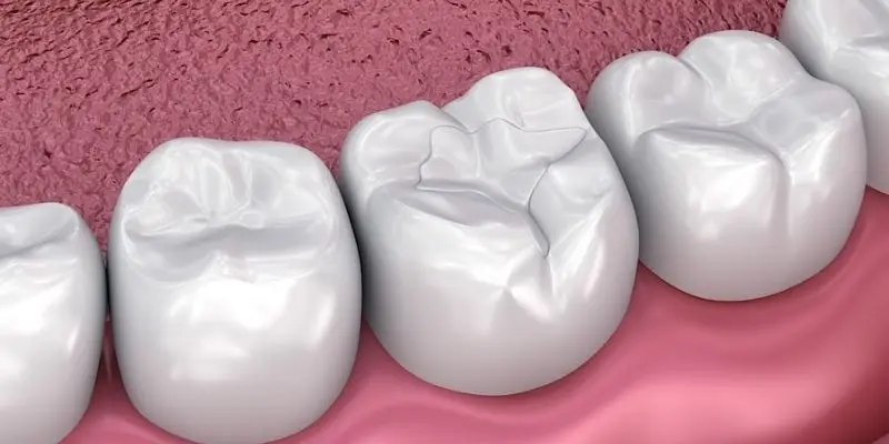 ظهور رنگ های بلیچ و لبخند هالیوودی - رنگ دندان برای کامپوزیت و لمینت